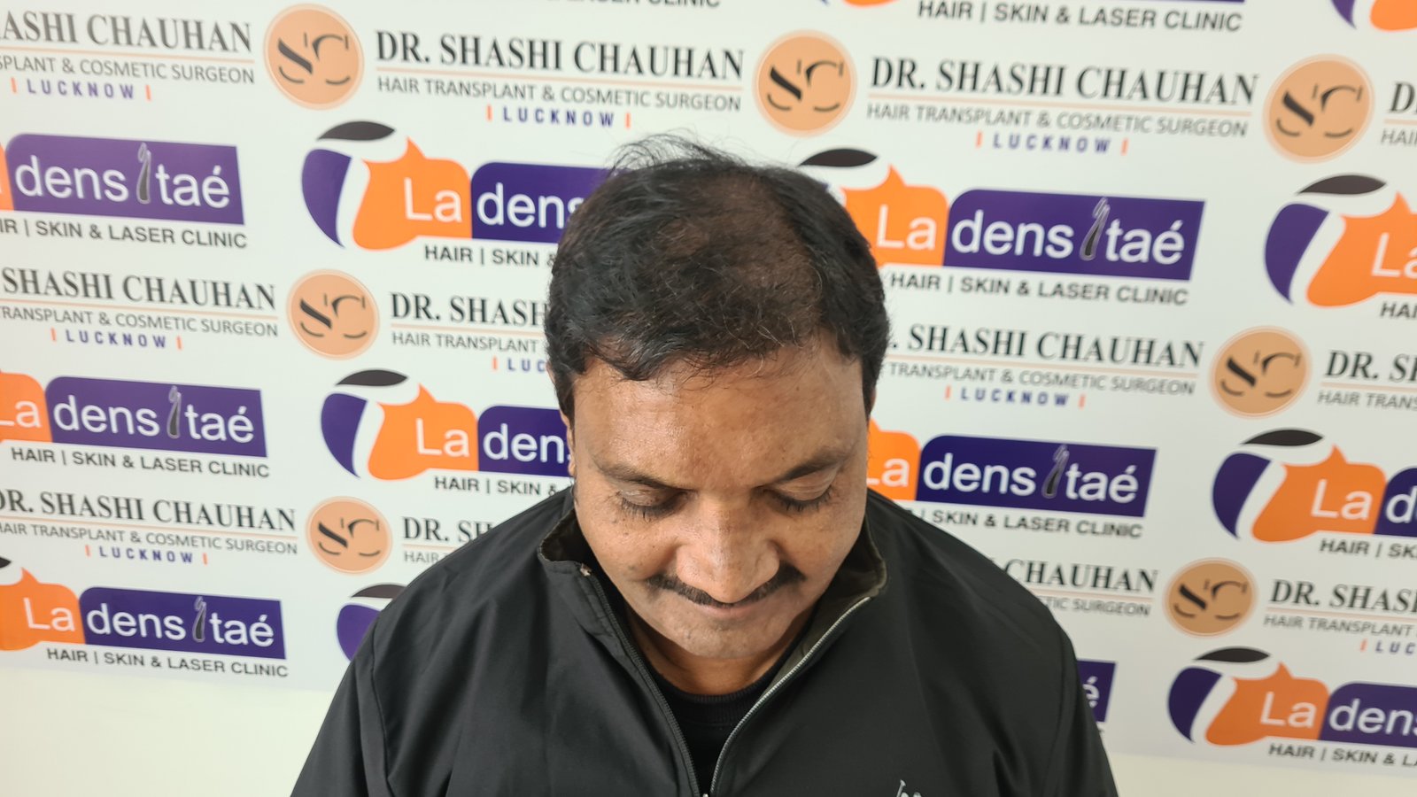 AK Singh After Hair Transplant